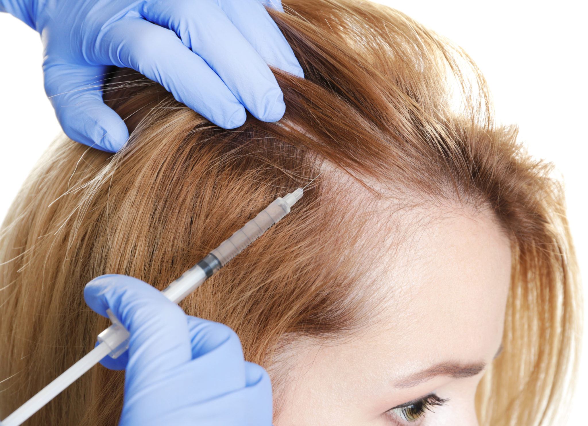 Сильное лечение волос. Hair treatment мезотерапия. Мезо волосистой части головы. PRP плазмотерапия для волос. Мезотерапия для волос.